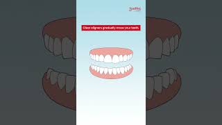 Unleash your perfect smile with toothsi [upl. by Ileek]