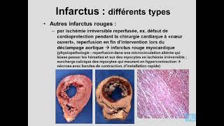 7  Ischémie Infractus Partie 3 [upl. by Eittocs]