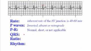 ECG Junctional Rhythm [upl. by Brigit]