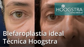 Blefaroplastía ideal  Técnica Hoogstra 21150 [upl. by Siwel]