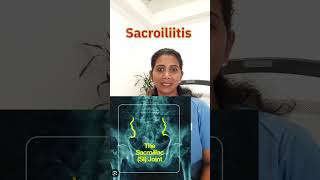 Sacroiliitis [upl. by Nij]