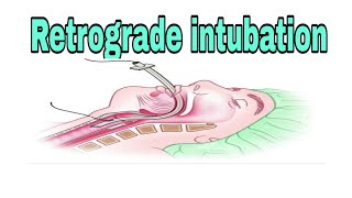 Retrograde intubation its indication and contra indication anaesthesiawithbabar2576 [upl. by Ayhay818]