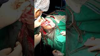 Craniotomy Procedure mbbsdairies mbbs aiimsdelhi biharmedicalcollege medico doctor [upl. by Ossy]