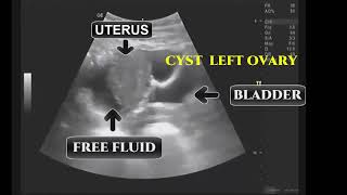 SIMPLE OVARIAN CYST RUPTURED DURING ULTRASOUND [upl. by Sorce]