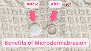 Benefits of Microdermabrasion Treatment [upl. by Melisent]