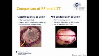 LITT for mesial temporal lobe epilepsy by Chengyuan Wu [upl. by Meer304]