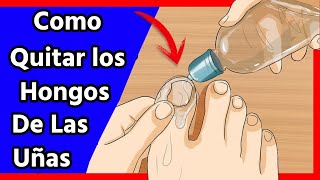 Cómo acabar los Hongos en las Uñas [upl. by Cerelly]