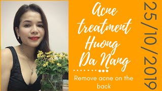 Acne treatment Hương Đà NẵngRemove acne on the back 25102019 [upl. by Miran]