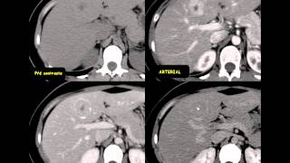 Hiperplasia nodular focal [upl. by Rafael]