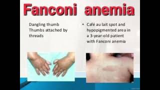 Fanconi anemia History mrcpch Clinical [upl. by Ellenyl]