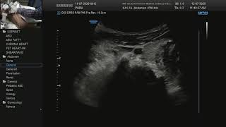 Doppler Subclavian Steal [upl. by Reichel]