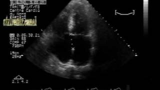 atrioventricular canal septaldefectintermediate form [upl. by Iinden]