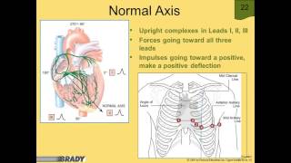 Axis Deviation in the 12Lead ECG [upl. by Akcirderf]