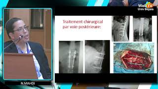 Fracture du rachis dorsolombaire NMAHDI H HOCINE I DELLOUL [upl. by Niar819]