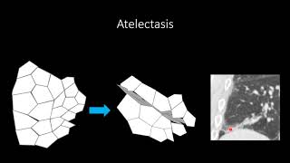 Atelectasis [upl. by Kedezihclem]