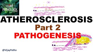 ATHEROSCLEROSIS  Part 2 Pathogenesis [upl. by Gairc]