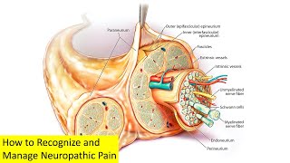 How to Recognize and Manage Neuropathic Pain [upl. by Materse236]