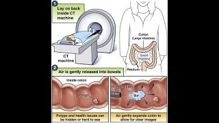 CT Colonography CT scan abdomen [upl. by Suoivatco]