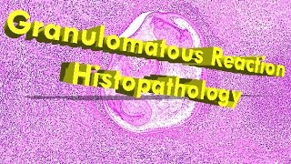 Granulomatous Reaction Histopathology [upl. by Yreva276]