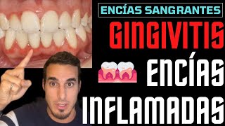 GINGIVITIS TRATAMIENTO y SÍNTOMAS  ENCIAS INFLAMADAS [upl. by Burch]