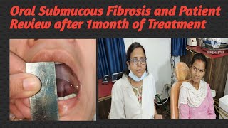 Oral Submucous Fibrosis and Patient Review after 1month of Treatment [upl. by Orms]