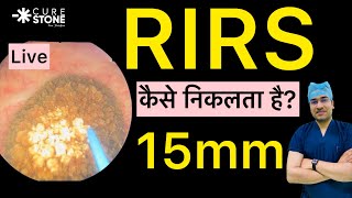 15 mm Kidney Stone laser treatment  RIRS  Retrograde intrarenal Surgery  Kidney stone Treatment [upl. by Franzen]