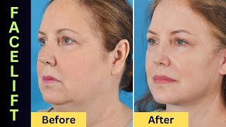 All You Need To Know Before Getting A Face Lift [upl. by Penrose]