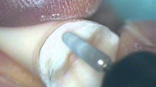 Crown Preparation Tooth Number 30 Part 2 [upl. by Nivan494]