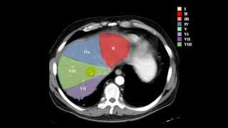 segmentación hepática [upl. by Nosniv]
