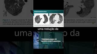 Aprisionamento aéreo o que é radiologia torax pneumologia [upl. by Adall]