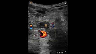 Popliteal Deep Venous Thrombosis  Ultrasound Image Interpretation [upl. by Delano]