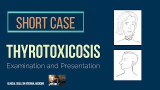 Thyrotoxicosis  Short Case [upl. by Nyliahs]