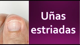 Uñas estriadas ✅ Libérate de preocupaciones [upl. by Odranoel]