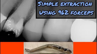 Simple Premolar Extraction with My 962 Forceps [upl. by Nnaxor]