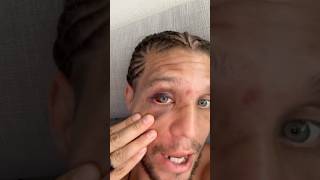 🙏👁️ BRIAN ORTEGA REACTS AND GIVES A HEALTH UPDATE AFTER LOSS TO DIEGO LOPES AT NOCHE UFC [upl. by Areic]