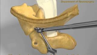 Posterior Reduction of Atlantoaxial Dislocation and Basilar Invagination [upl. by Eiramyelhsa]