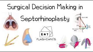 Surgical Decision Making in Septorhinoplasty  FRCS ENT Exam Essentials [upl. by Enuj]