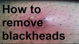 How to remove blackheads [upl. by Isa]