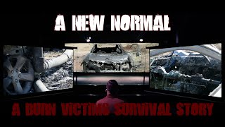 A New Normal A Burn Victims Survival Story [upl. by Franek965]