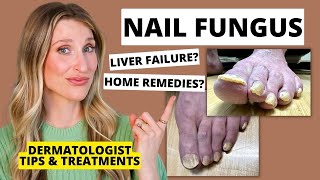 Dermatologist Shares Treatments for Nail Fungus amp Prevention Tips  Dr Sam Ellis [upl. by Granger]