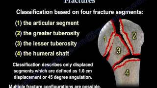 Proximal Humerus Fractures classification  Everything You Need To Know  Dr Nabil Ebraheim [upl. by Engdahl]