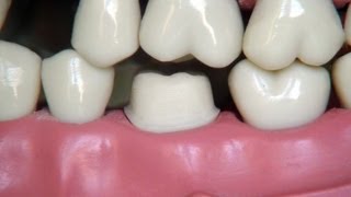 Full metal crown preparation  for dental students [upl. by Rennerb]