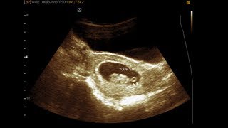 Ultrasound cases 404 of 2000  Echogenic yolk sac  A marker for aneuploidy [upl. by Sedicla]