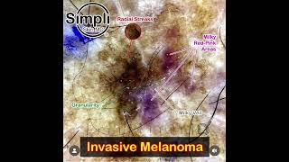 Invasive Melanoma Dermoscopy [upl. by Nedak386]