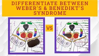 Midbrain Syndromes  Benedikts VS Webers syndrome [upl. by Adah]