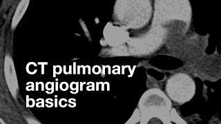 Pulmonary CT Angiogram Basics [upl. by Teilo]