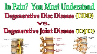 In Pain You Must Understand Degenerative Joint Disease vs Degenerative Disc Disease  Dr Mandell [upl. by Lasonde]