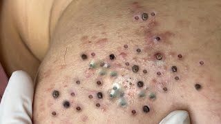 Big Cystic Acne Blackheads Extraction Blackheads amp Milia Whiteheads Removal Pimple Popping  3595 [upl. by Eniortna79]