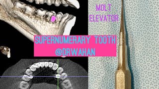 Lingually Positioned Supernumerary Tooth Extraction using Molt Elevator and Periotomes drwahan [upl. by Leona146]