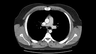 Anatomy of CT scans Thoracic cavity [upl. by Bain198]